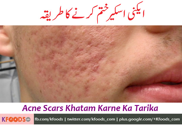 AOA..Sir hope you are in good health, please suggest me something for acne scars these are 7,8 year old scars ..plz guide me what to do. thanks