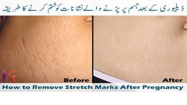 tips-to-remove-stretch-marks-after-pregnancy-urdu-totkay