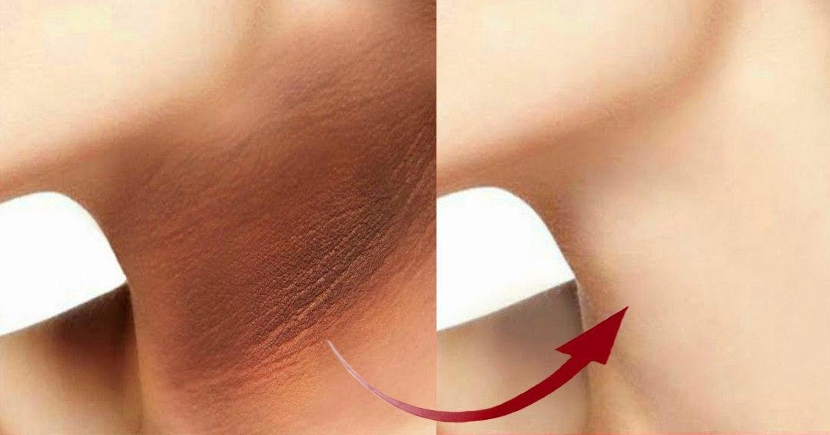 How can I remove blackness from my neck?