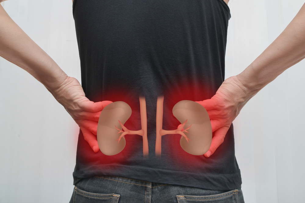 How can I prevent kidney stones naturally?