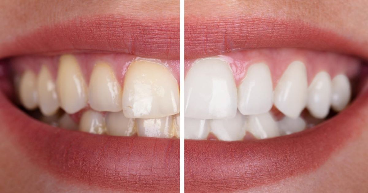 How do you dissolve dental plaque naturally?