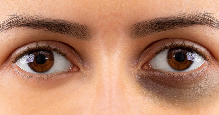 How to reduce dark circles around the eyes: