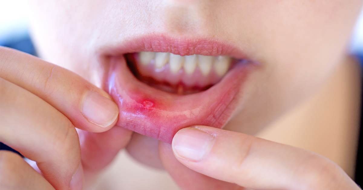 It is very easy to avoid if you are bothered by mouth ulcers. Remove blisters from the refrigerator immediately after use