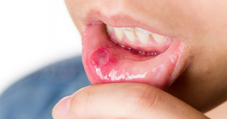 We often get blisters in our mouths, but have you ever wondered what causes blisters to appear? Learn the causes and treatment of blisters