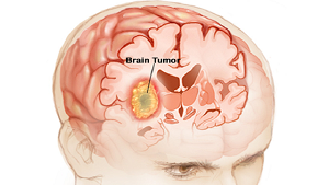 Brain Tumor Symptoms In Urdu