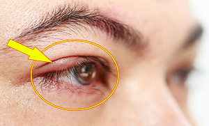 آنکھ کی گوہانجی (دانہ) کا آسان گھریلو علاج