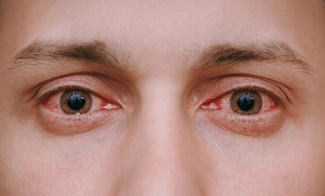 آنکھوں کی سنگین بیماری کی ابتدائی علامات ۔۔ انہیں نظر انداز کرنا خطرناک ہوسکتا ہے