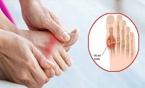 اگر آپ کے جوڑوں میں درد ہے اور پاؤں کے انگوٹھوں میں سوجن آ رہی ہے تو زرا رُکیں۔۔۔ جان لیں کہ کہیں یہ یورک ایسڈ کی علامات تو نہیں