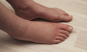 اگر آپ کے پاؤں بھی سوجن کا شکار رہتے ہیں تو یہ ان بیماریوں کی علامت ہوسکتی ہے