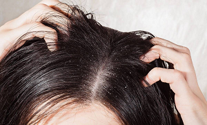 بالوں میں خشکی بڑھانےوالی 5 غذائیں، اگر آپ کے بال روکھے ہیں تو یہ غذائیں نہ کھائیں