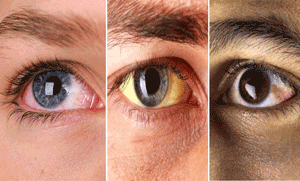 زرد رنگ کی آنکھیں کون سی بیماری کی نشاندہی کرتی ہیں؟ 5 مہلک بیماریاں جس کا پتہ آپ اپنی آنکھوں سے بھی لگا سکتے ہیں