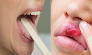 منہ کا السر کیا ہے اور آپ اس سے کیسے چھٹکارا حاصل کر سکتے ہیں جانیں اس کا آسان قدرتی علاج