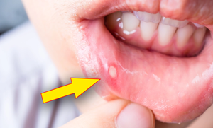 منہ کے چھالوں کی وجہ سے کھانا پینا دشوار ہوگیا ہے؟ آپ کے گھر کے کچن سے ہی اس کے 5 قدرتی علاج