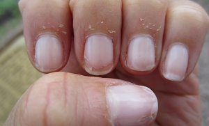 ناخنوں کے ارد گرد جلد کے پھٹے ہونے کی وجوہات ، پھٹی ہوئی جلد کا علاج کیسے کریں؟