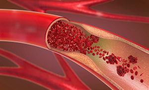 کولیسٹرول صرف دل کا ہی دشمن نہیں بلکہ جانیں کولیسٹرول سے ٹانگوں کو نقصان پہنچنے کی 10 علامات
