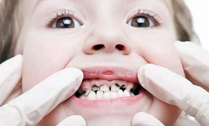 کیا آپ جانتے ہیں کہ دانتوں میں کیڑا کیوں لگتا ہے؟ جانیئے اس کی وجوہات اور آسان گھریلو علاج تاکہ آپ کے دانت بھی رہیں صحت مند اور مضبوط