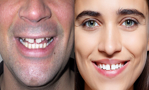 کیا آپ کے دانت بھی ایسے ہیں، ان کے درمیان فاصلہ ہونے کا کیا مطلب ہوتا ہے؟ جانیں دانتوں میں چھپے راز