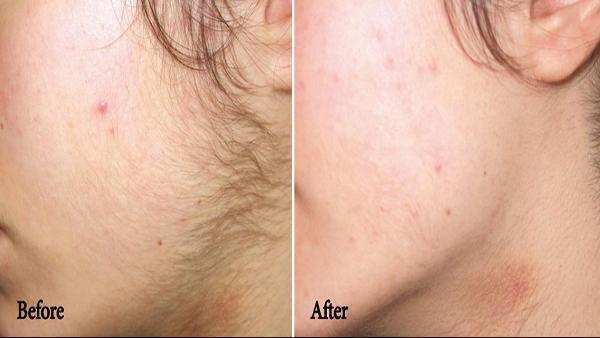 Home Remedies For Unwanted Facial Hair