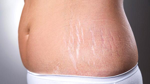 Tips to Remove Stretch Marks After Pregnancy