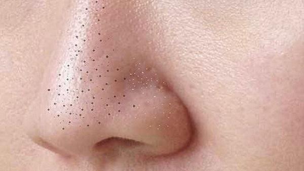 How to Reduce Blackheads