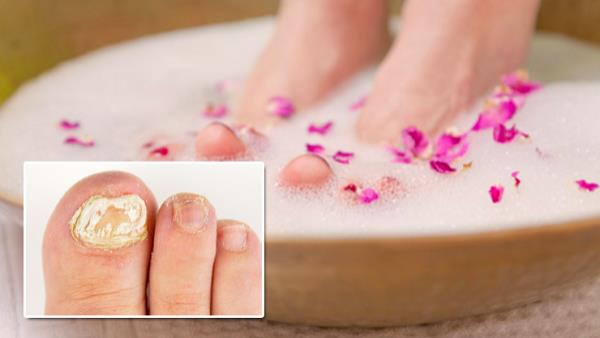 How to Cure Nail Fungus