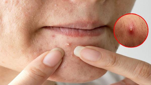 Chehre Ke Dane Khatam Karne Ka Tarika