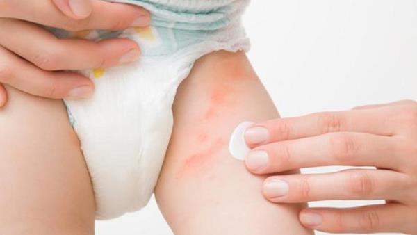 Diaper Rashes Se Nijat Pane Ka Tarika