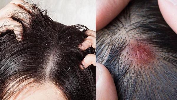 Balon Mein Kharish Ka Ilaj