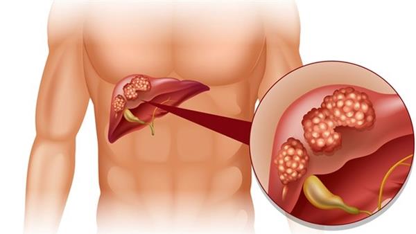 Home Remedies for Fatty Liver