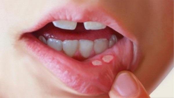 Cure Mouth Ulcer in One Day