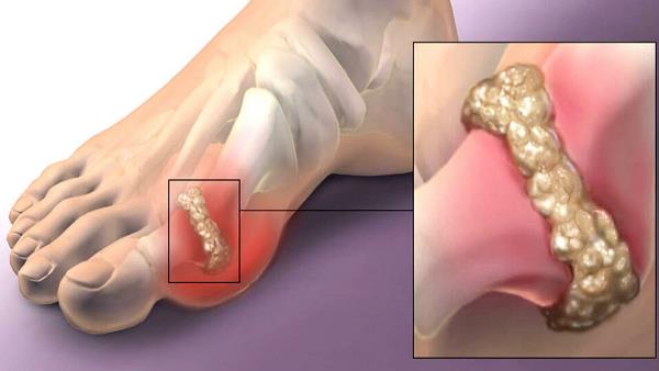 Uric Acid Control Karne Ka Tarika