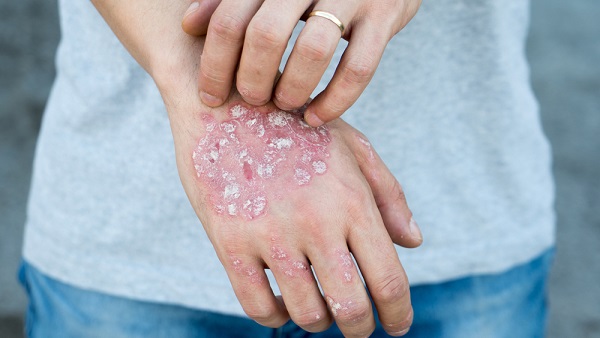 Natural Home Remedies for Psoriasis Treatment