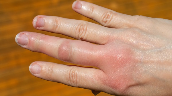 How To Get Rid Of Swollen Fingers During Pregnancy